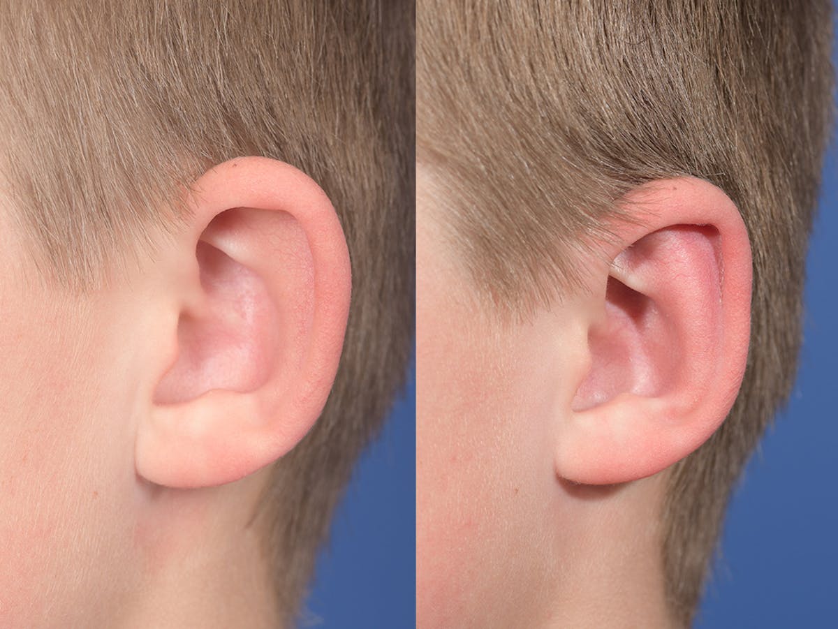 Otoplasty Before & After Gallery - Patient 145010 - Image 4