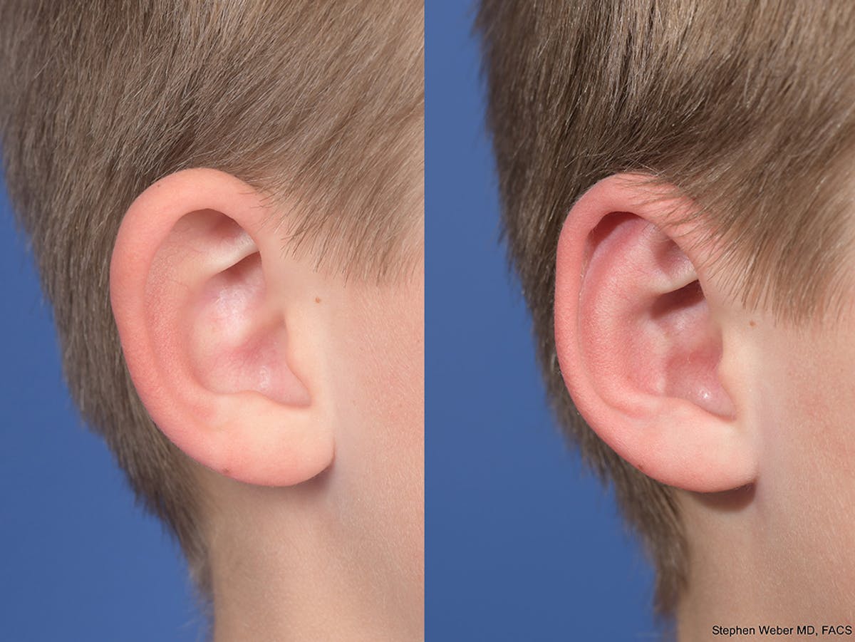 Otoplasty Before & After Gallery - Patient 145010 - Image 5