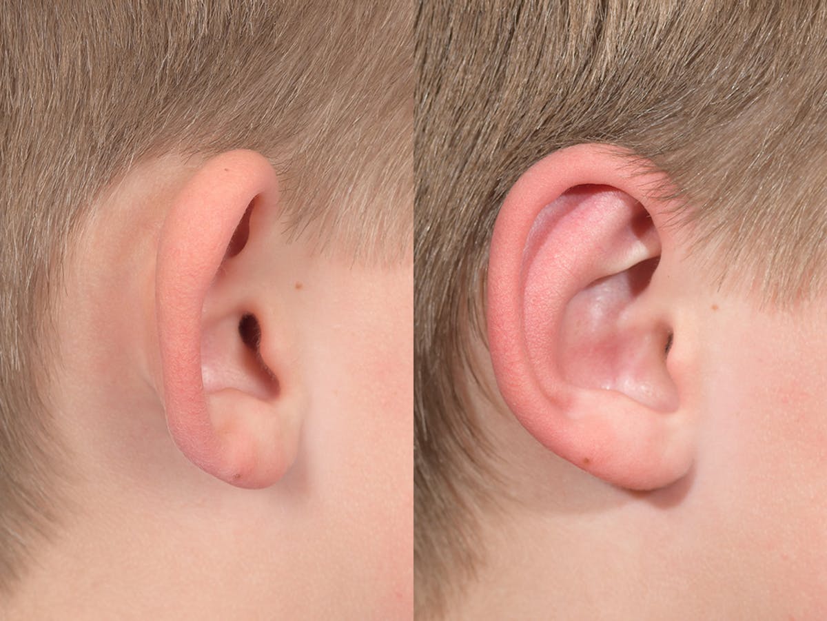 Otoplasty Before & After Gallery - Patient 145010 - Image 6
