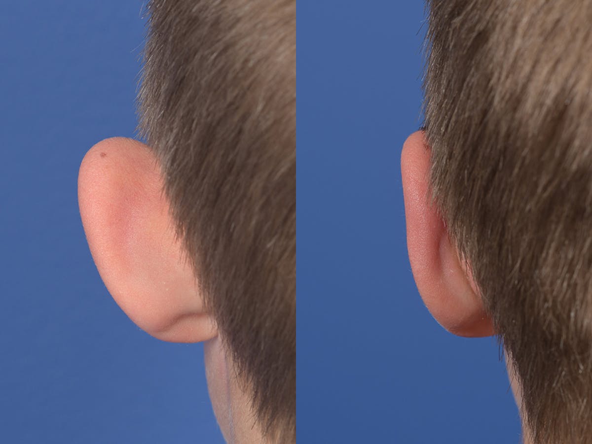 Otoplasty Before & After Gallery - Patient 145010 - Image 7