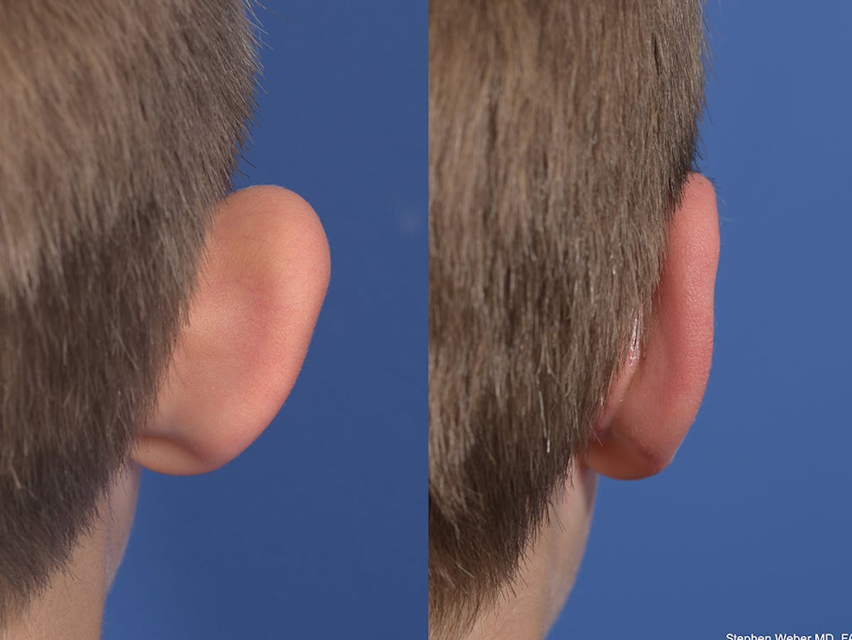 Otoplasty Before & After Gallery - Patient 145010 - Image 8