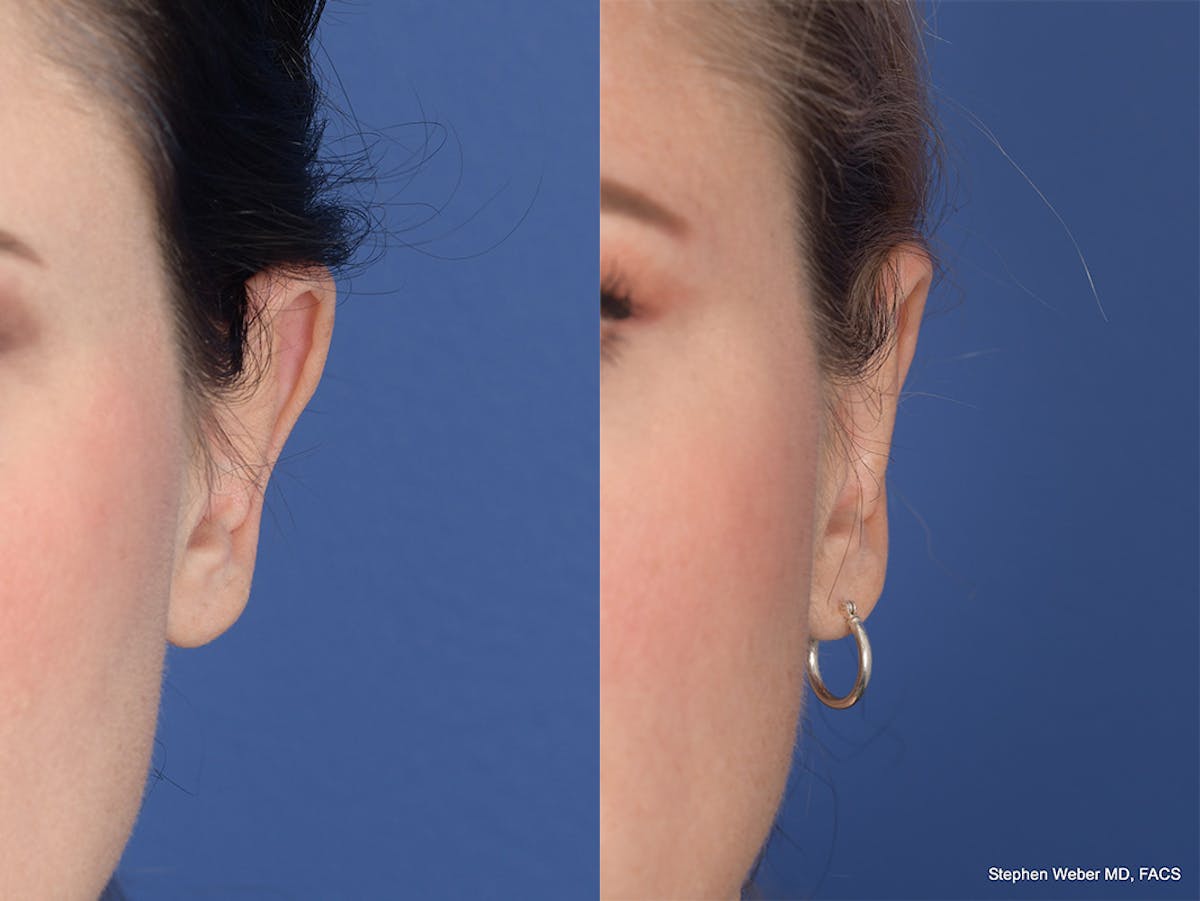 Otoplasty Before & After Gallery - Patient 252794 - Image 1