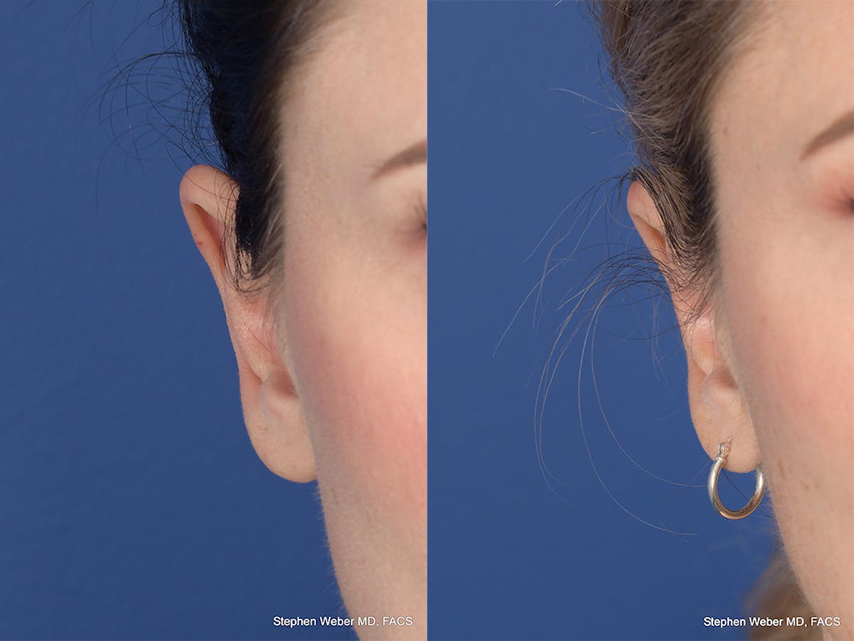 Otoplasty Before & After Gallery - Patient 252794 - Image 2