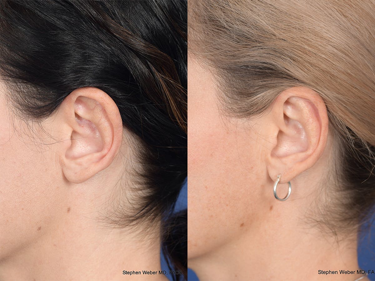 Otoplasty Before & After Gallery - Patient 252794 - Image 3