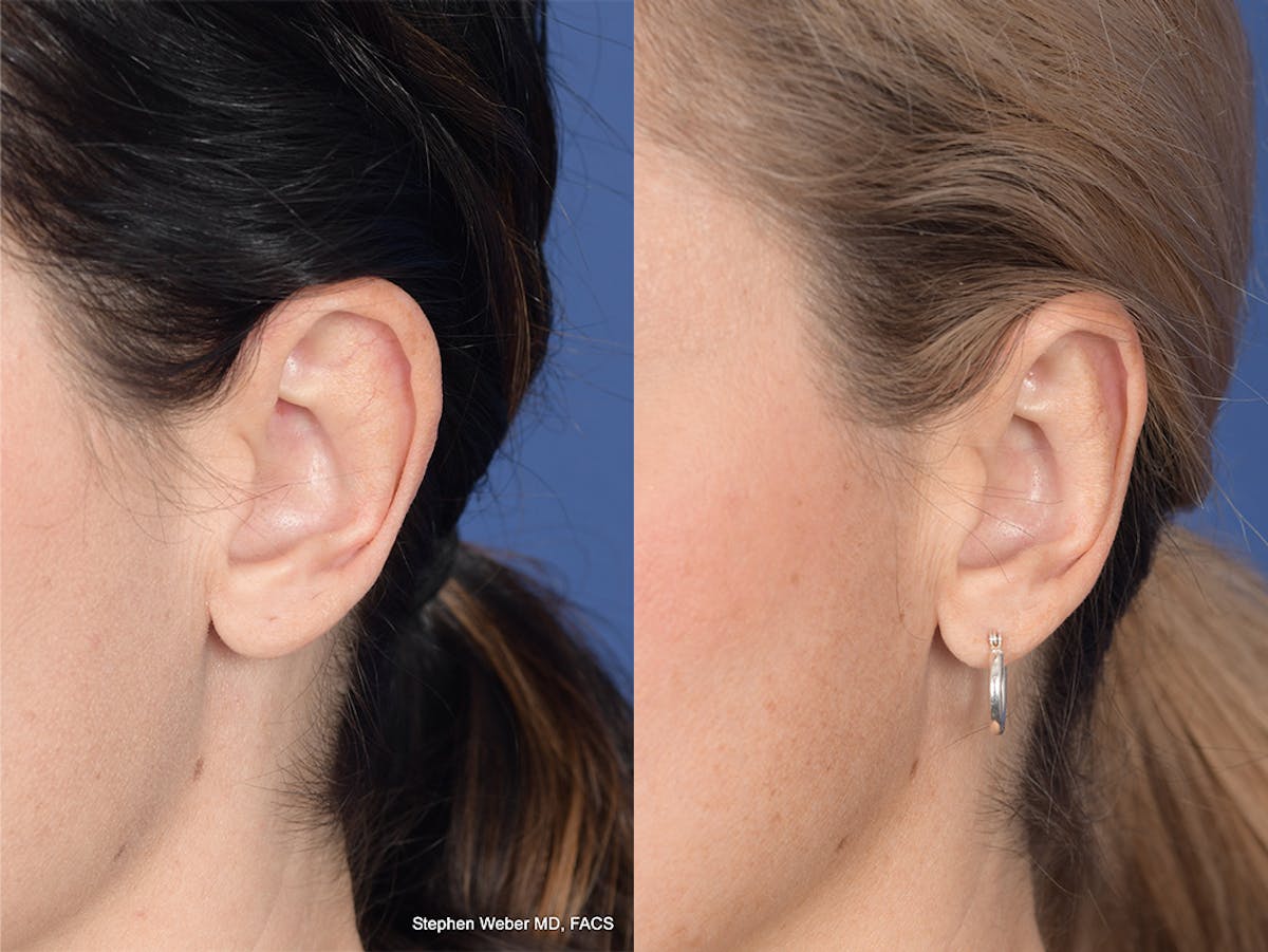 Otoplasty Before & After Gallery - Patient 252794 - Image 4