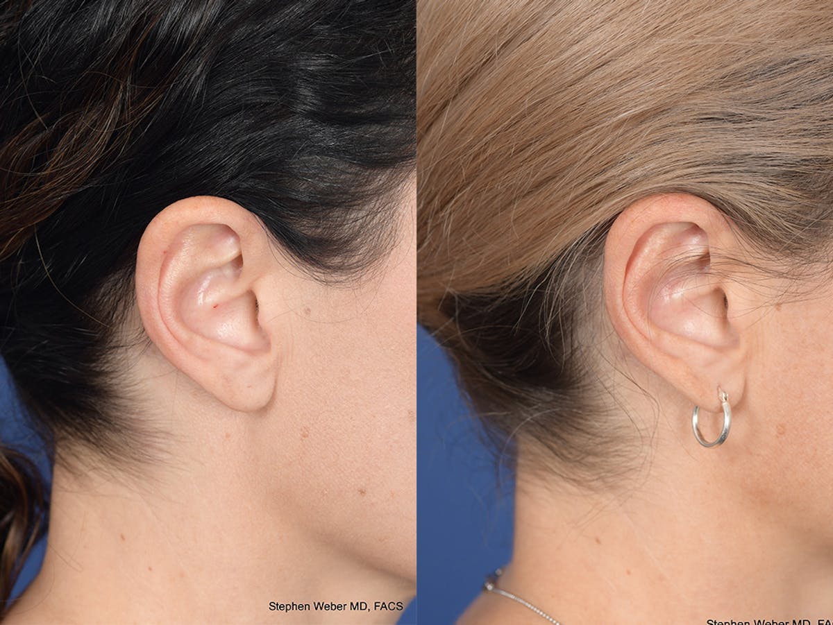 Otoplasty Before & After Gallery - Patient 252794 - Image 5