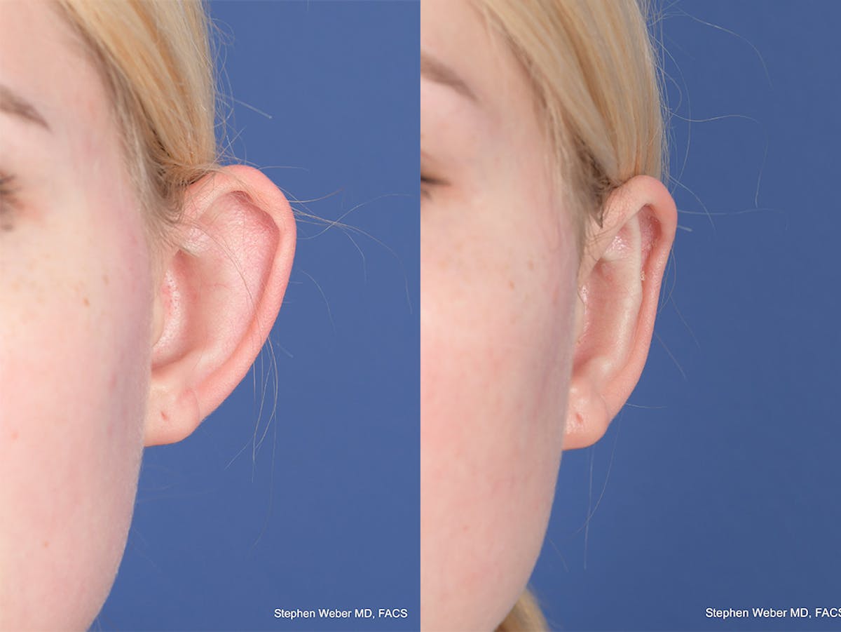 Otoplasty Before & After Gallery - Patient 837331 - Image 1