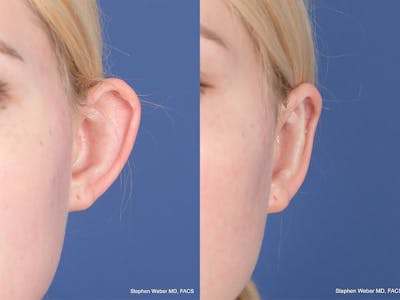 Otoplasty Before & After Gallery - Patient 837331 - Image 1