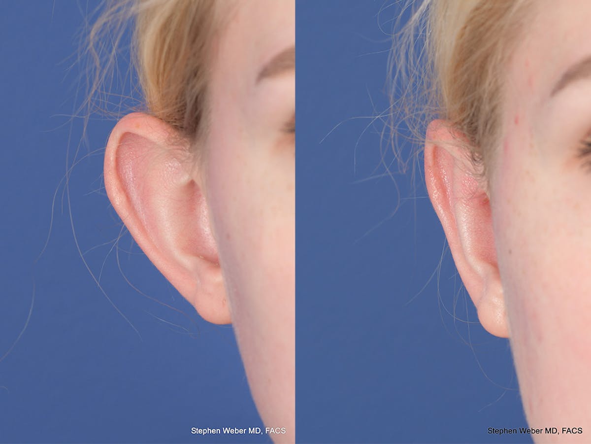 Otoplasty Before & After Gallery - Patient 837331 - Image 2
