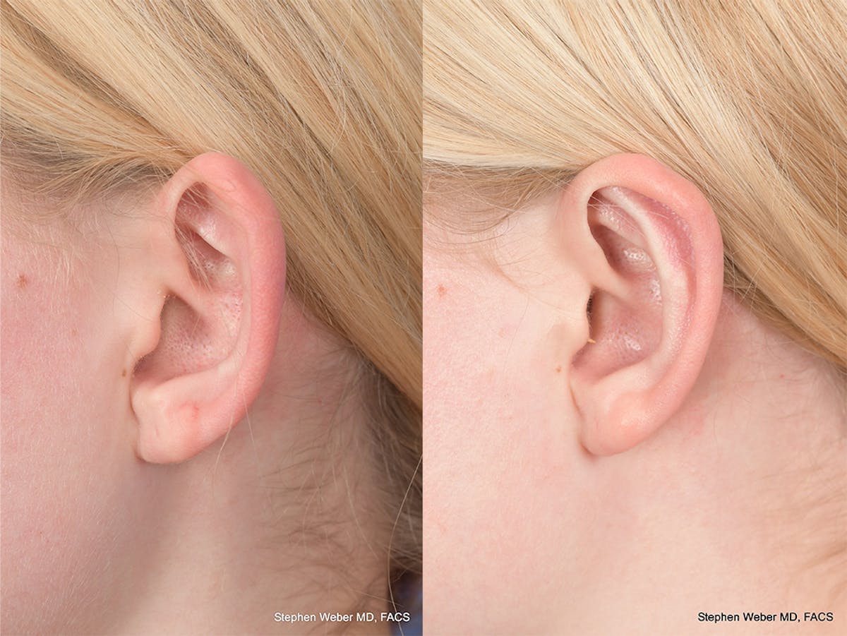 Otoplasty Before & After Gallery - Patient 837331 - Image 3