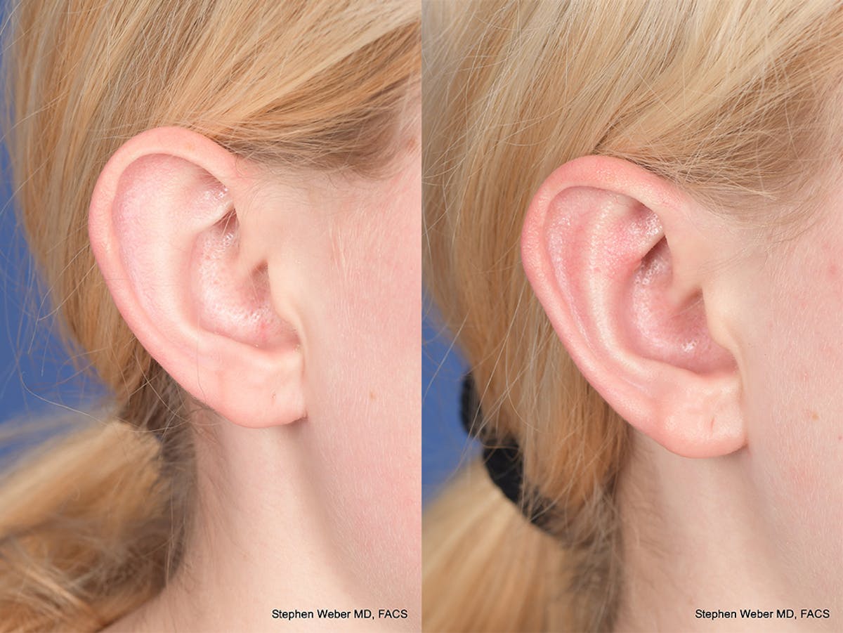Otoplasty Before & After Gallery - Patient 837331 - Image 5