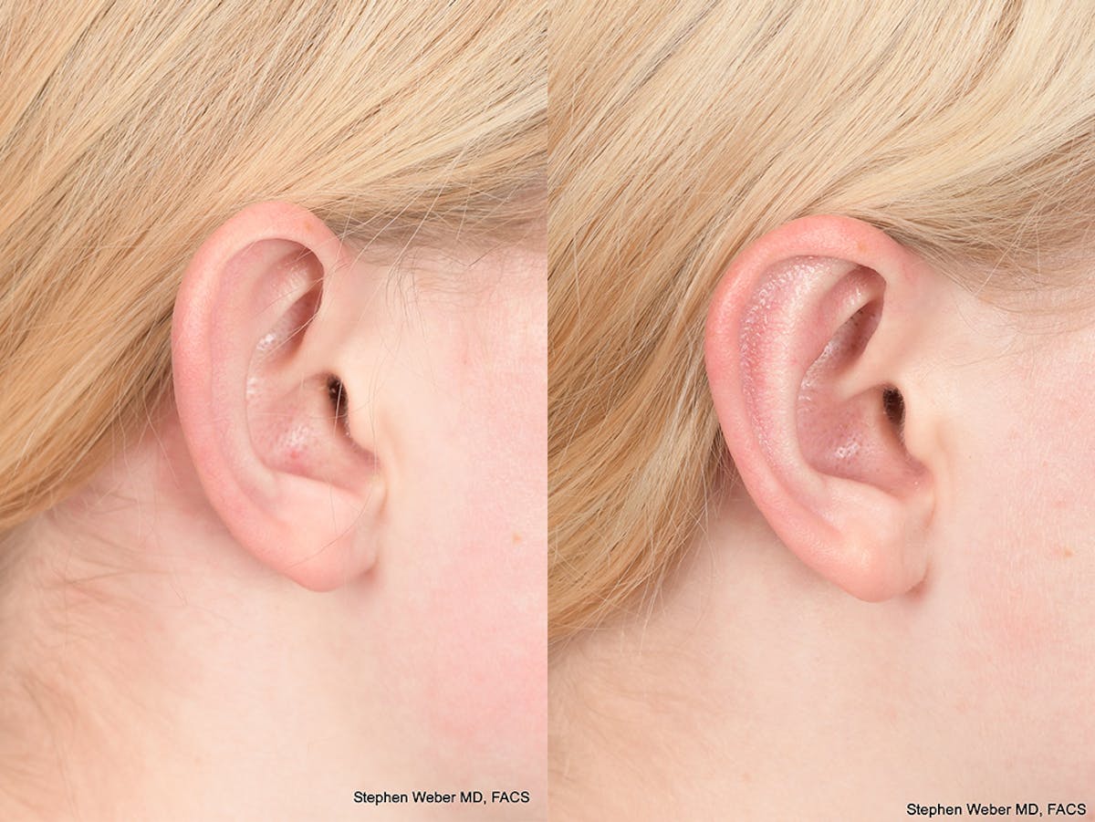 Otoplasty Before & After Gallery - Patient 837331 - Image 6