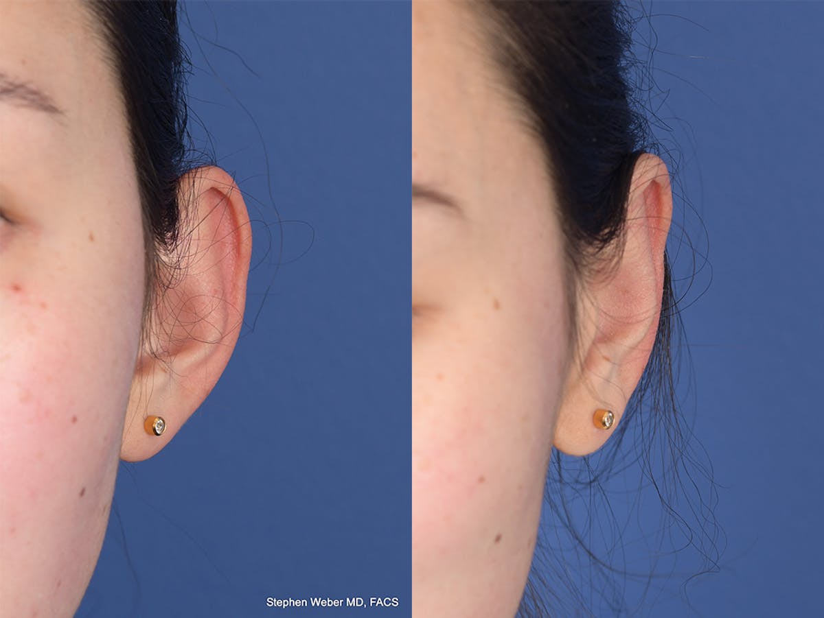 Otoplasty Before & After Gallery - Patient 648692 - Image 1