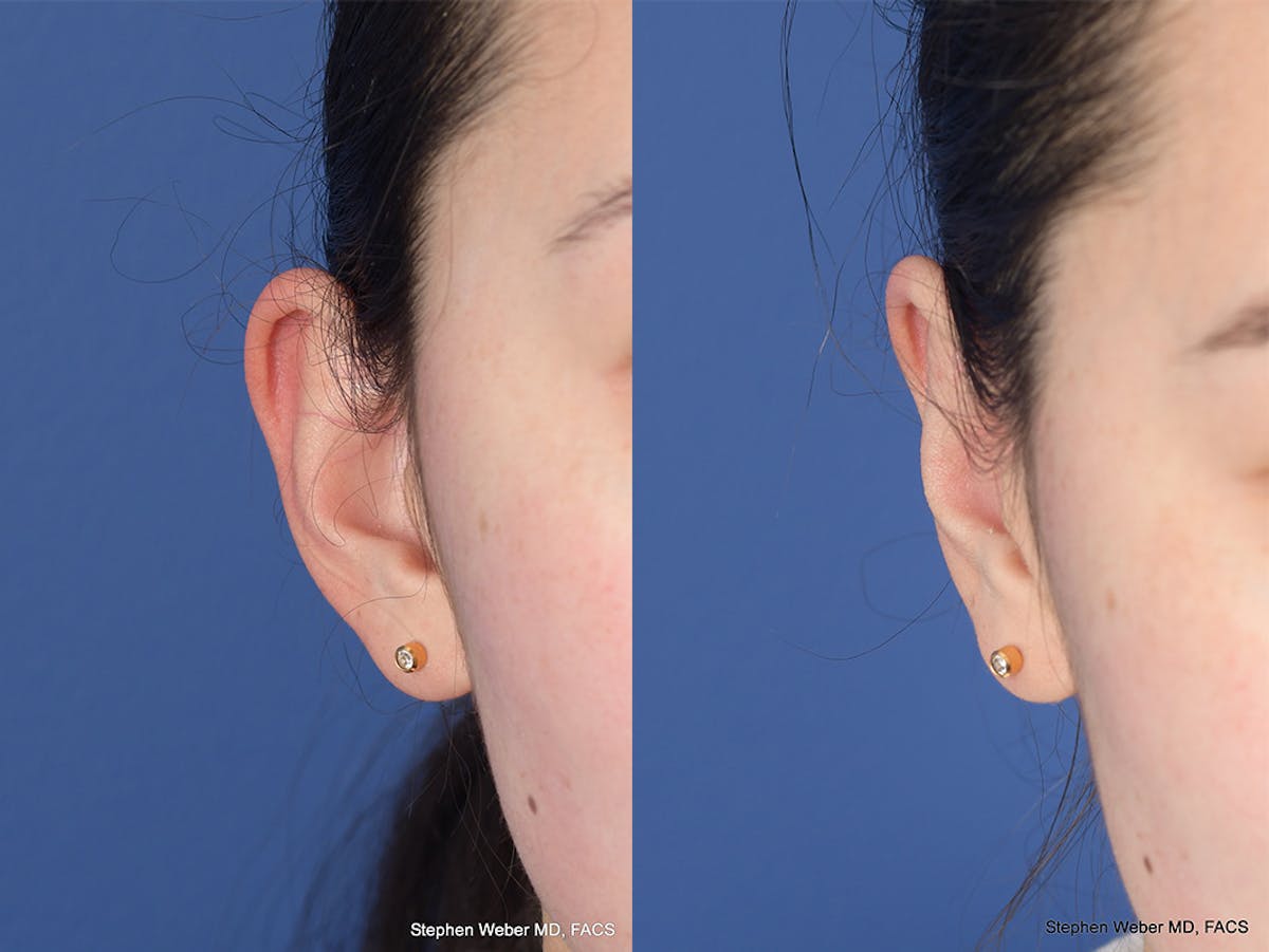 Otoplasty Before & After Gallery - Patient 648692 - Image 2