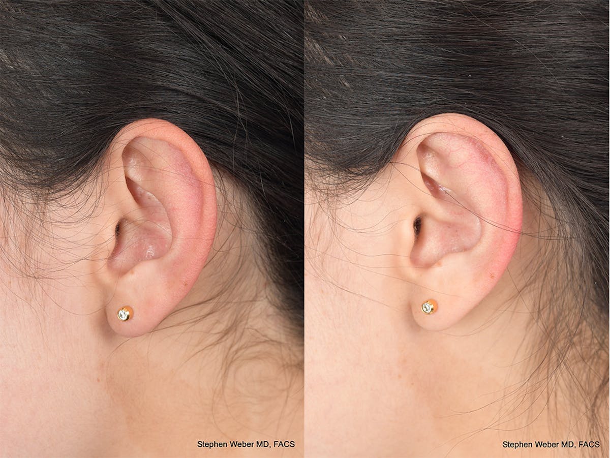 Otoplasty Before & After Gallery - Patient 648692 - Image 3