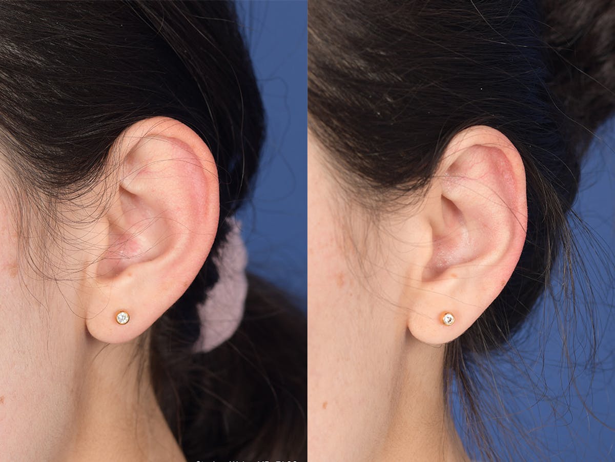 Otoplasty Before & After Gallery - Patient 648692 - Image 4