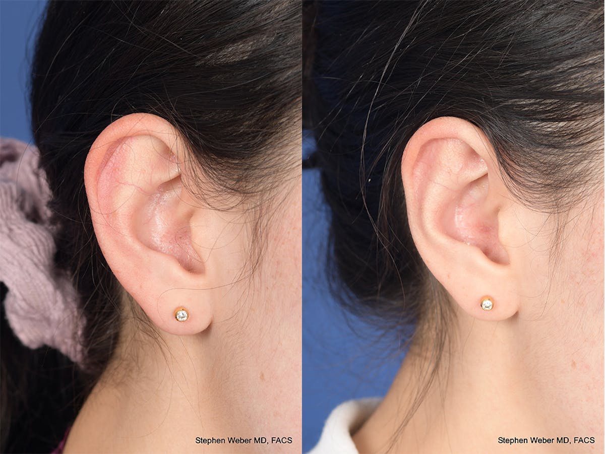 Otoplasty Before & After Gallery - Patient 648692 - Image 5