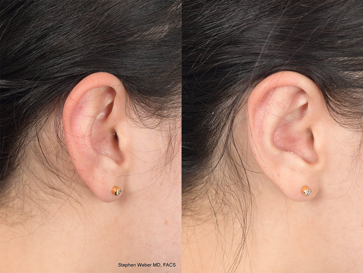 Otoplasty Before & After Gallery - Patient 648692 - Image 6
