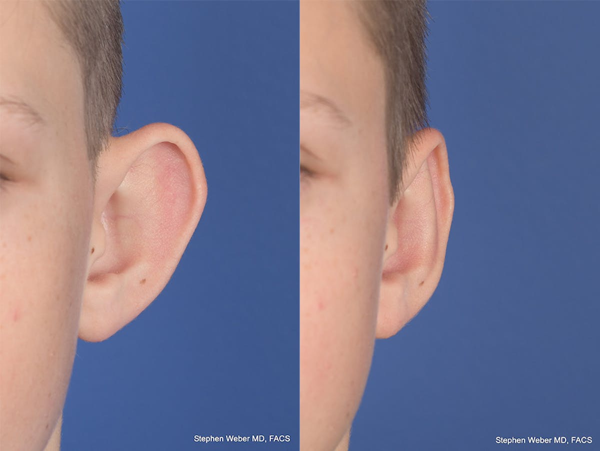 Otoplasty Before & After Gallery - Patient 243585 - Image 1