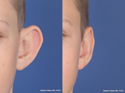 Otoplasty Before & After Gallery - Patient 243585 - Image 1