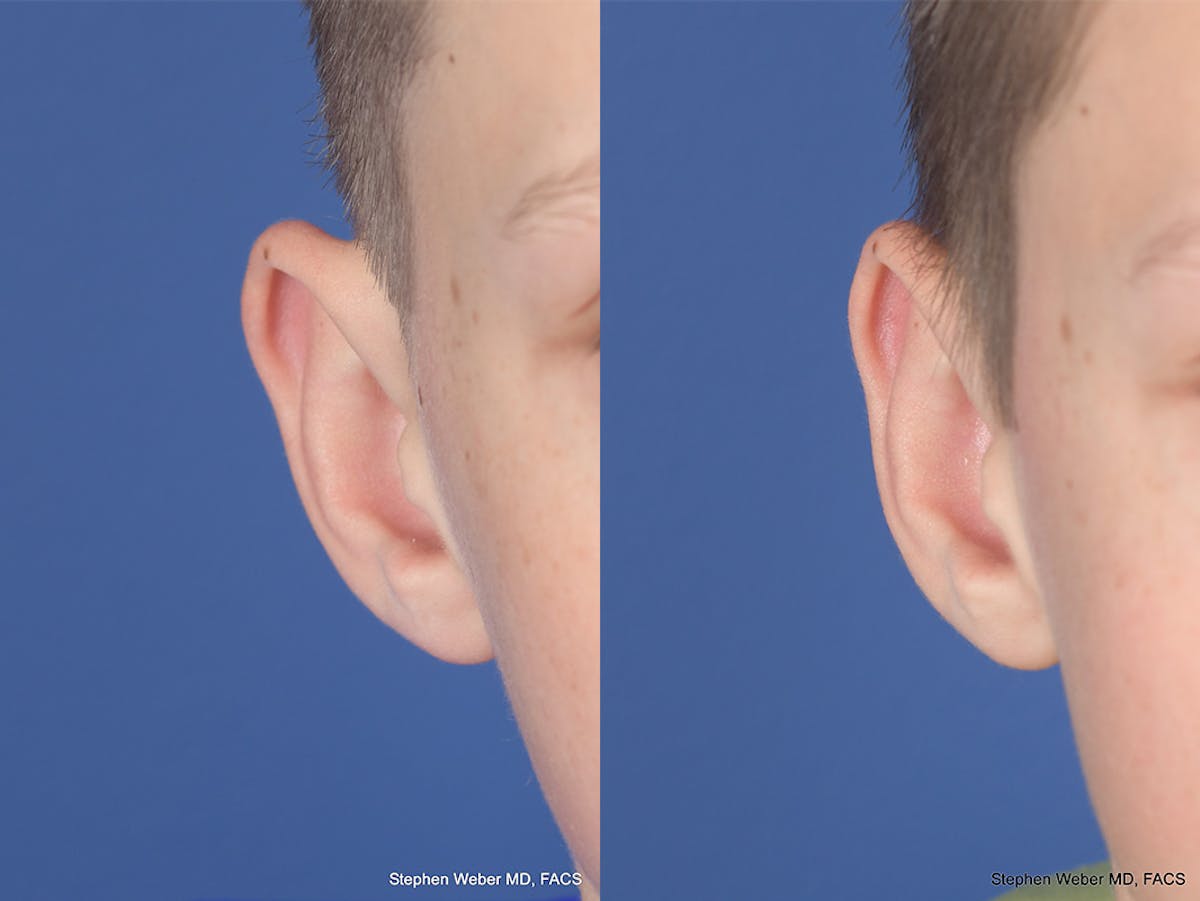 Otoplasty Before & After Gallery - Patient 243585 - Image 2
