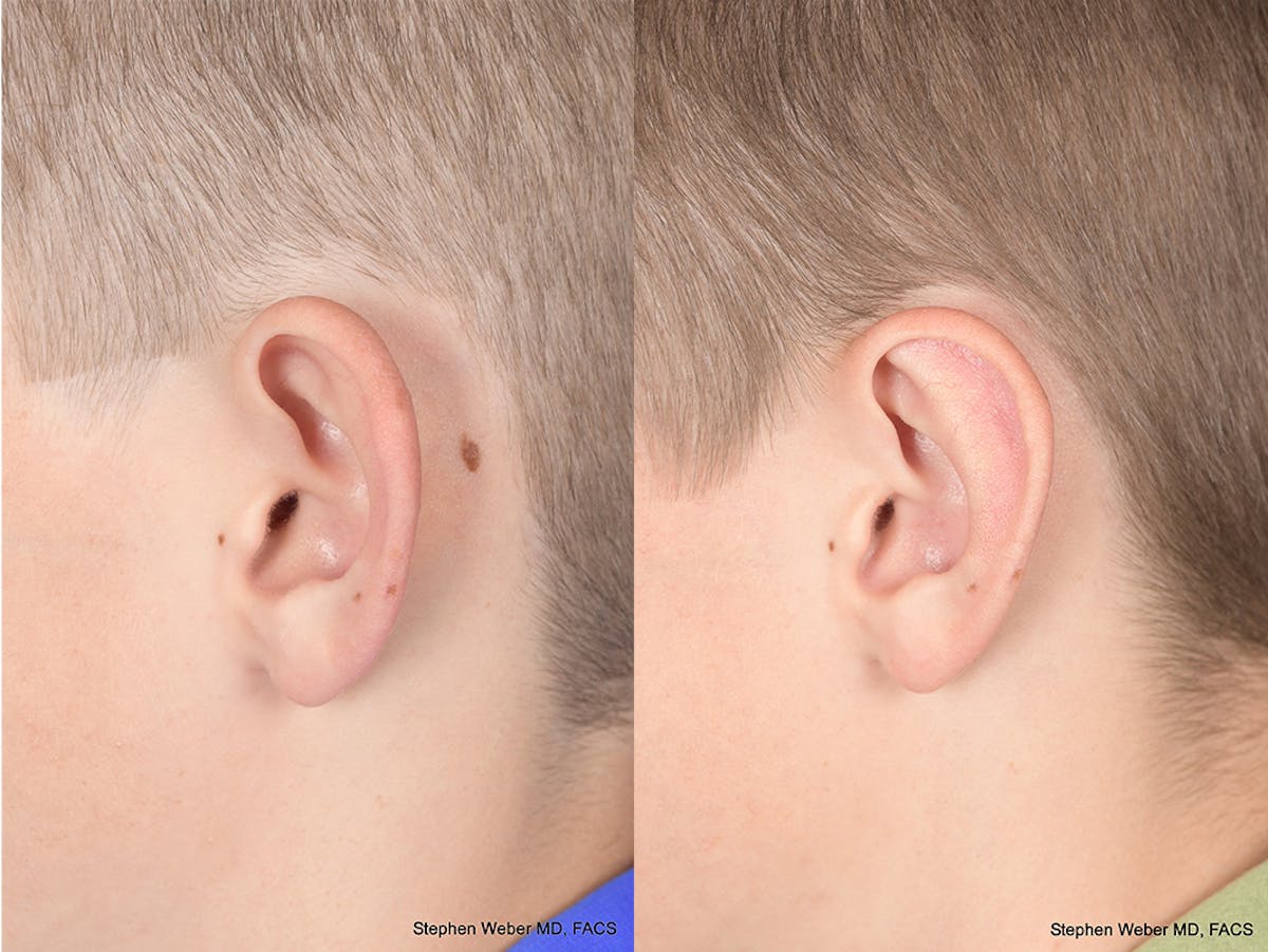 Otoplasty Before & After Gallery - Patient 243585 - Image 3