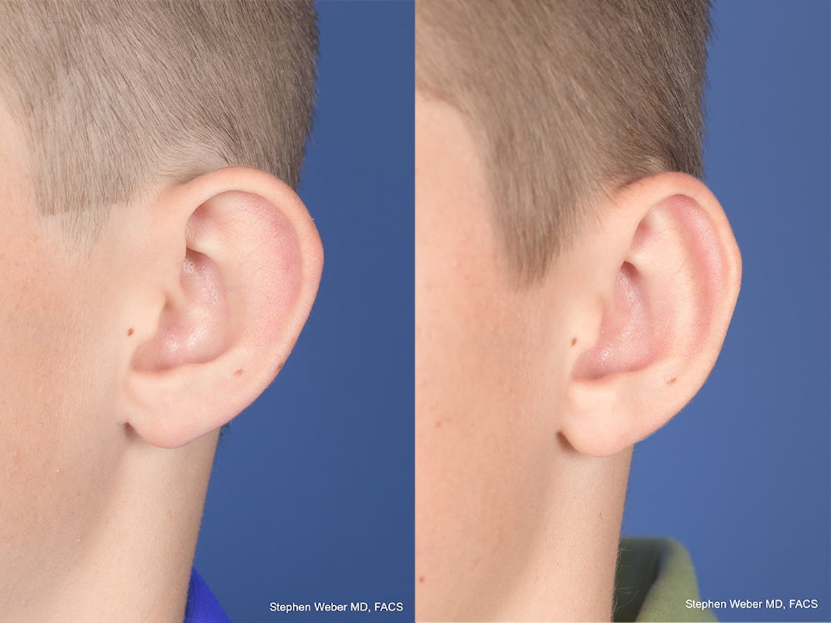 Otoplasty Before & After Gallery - Patient 243585 - Image 4