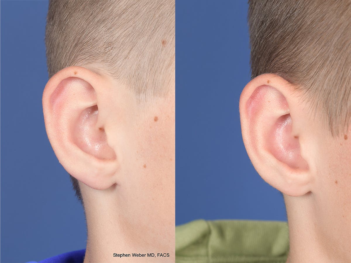 Otoplasty Before & After Gallery - Patient 243585 - Image 5