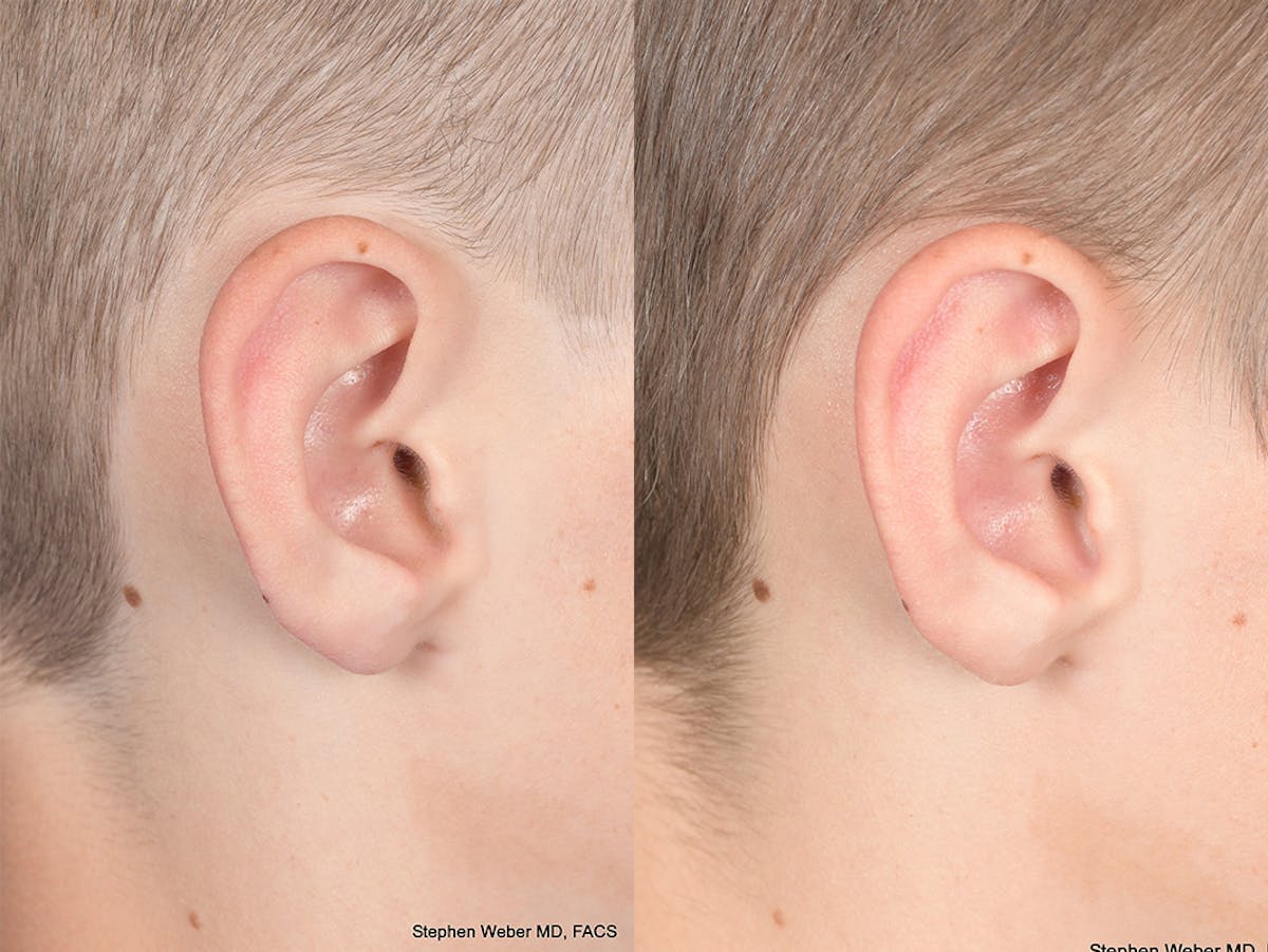 Otoplasty Before & After Gallery - Patient 243585 - Image 6