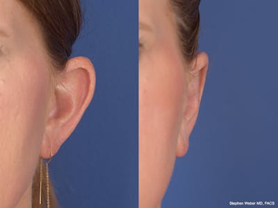 Otoplasty Before & After Gallery - Patient 114411 - Image 1
