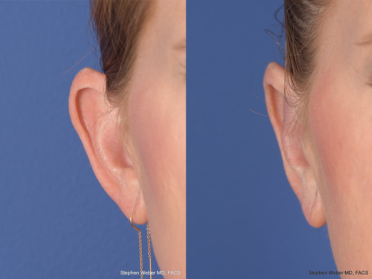 Otoplasty Before & After Gallery - Patient 114411 - Image 2