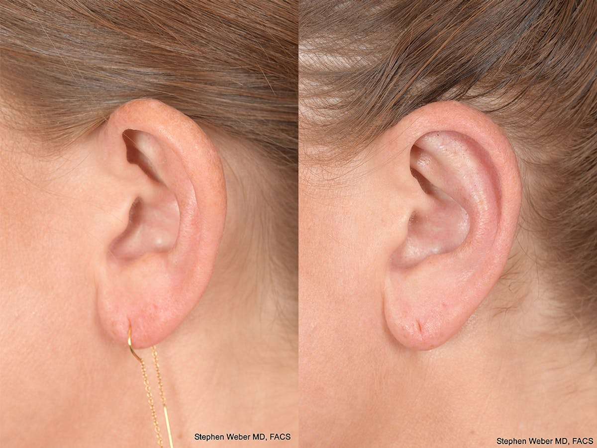 Otoplasty Before & After Gallery - Patient 114411 - Image 3