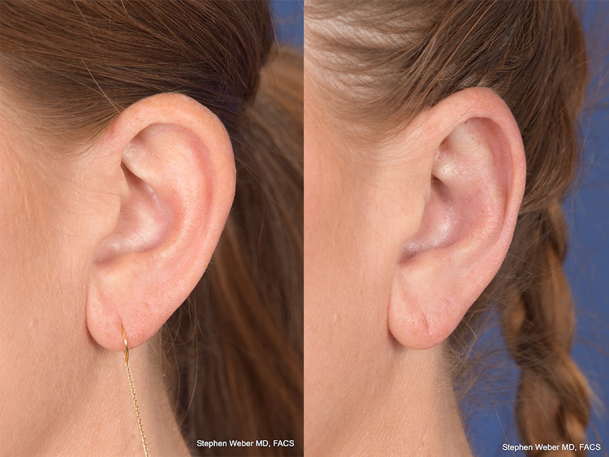 Otoplasty Before & After Gallery - Patient 114411 - Image 4