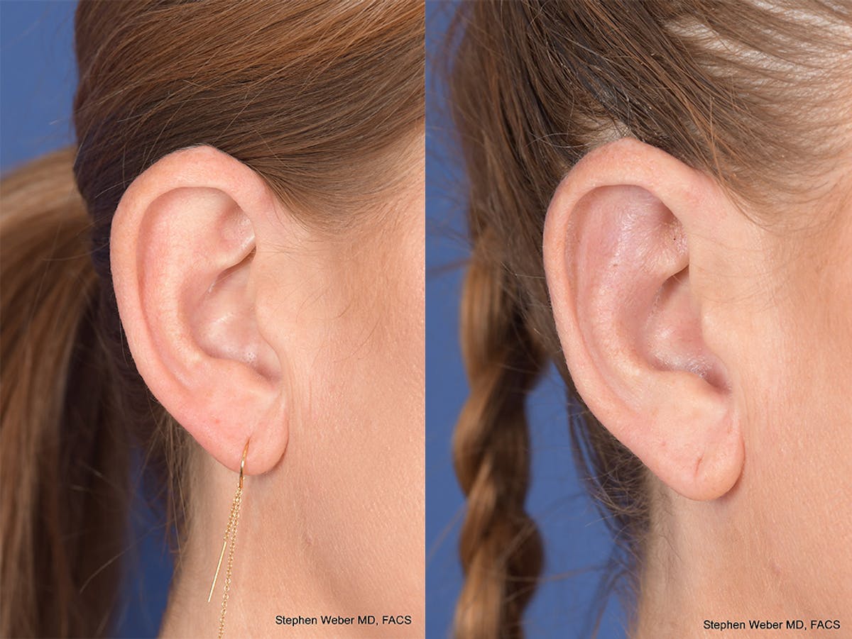 Otoplasty Before & After Gallery - Patient 114411 - Image 5