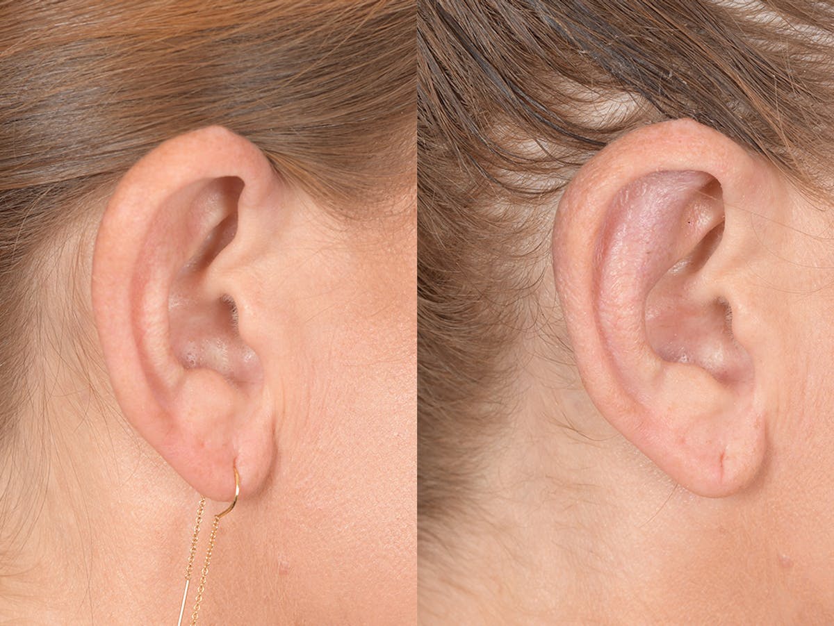 Otoplasty Before & After Gallery - Patient 114411 - Image 6