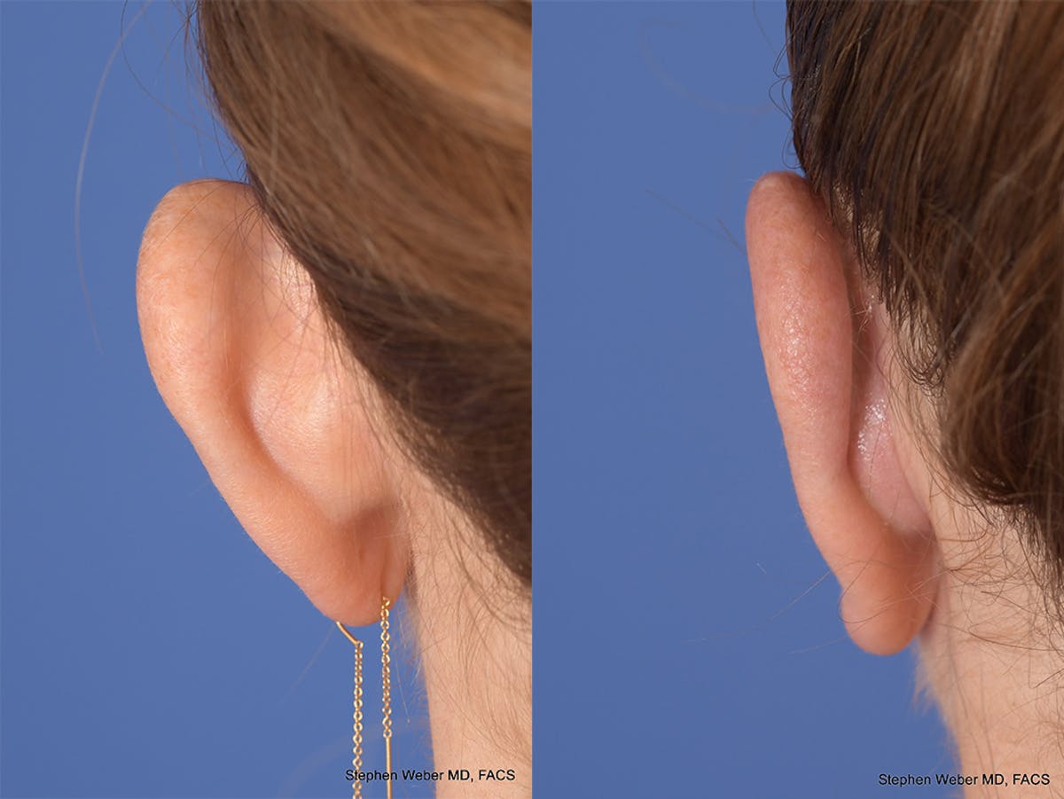 Otoplasty Before & After Gallery - Patient 114411 - Image 7