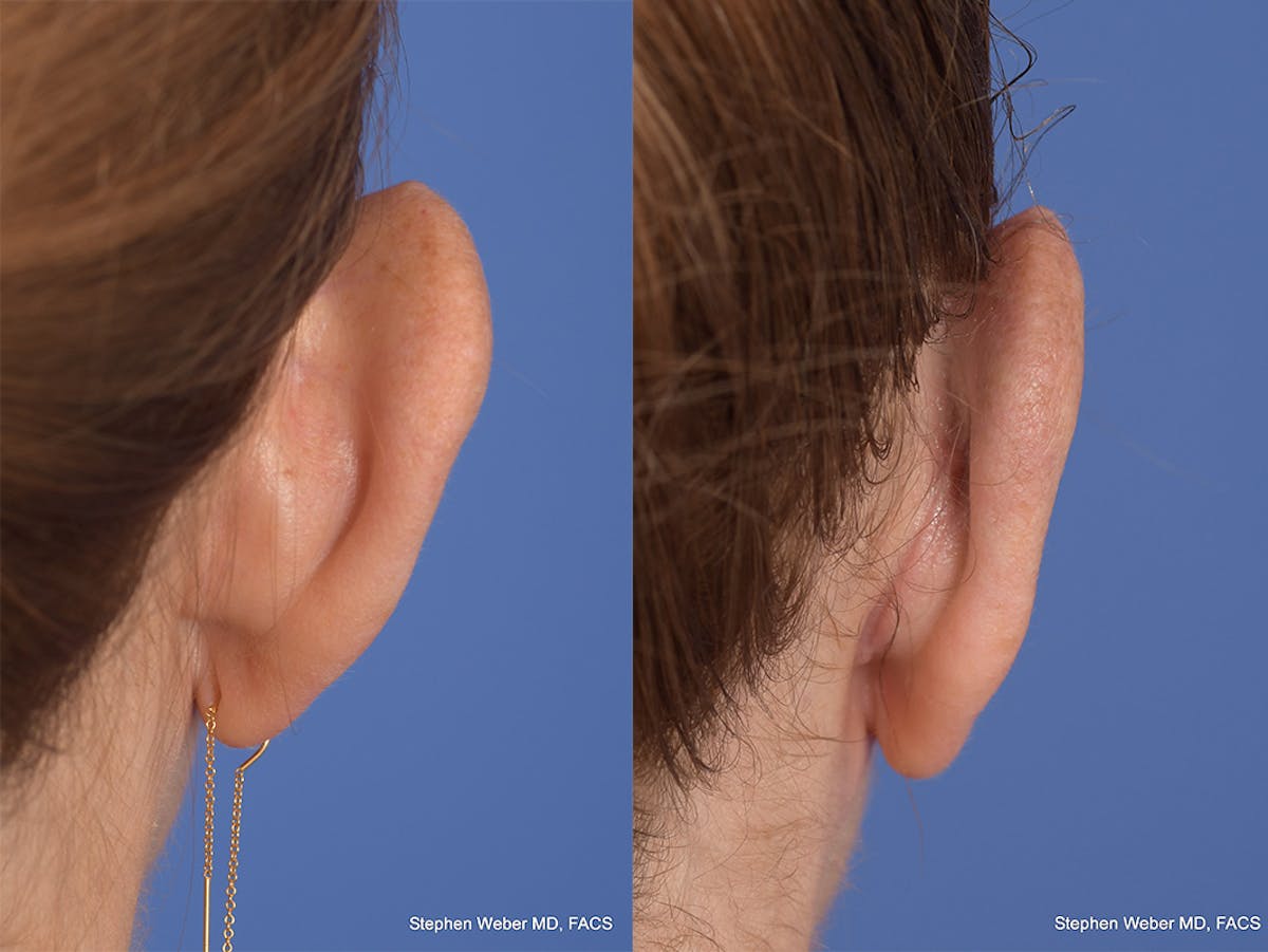 Otoplasty Before & After Gallery - Patient 114411 - Image 8