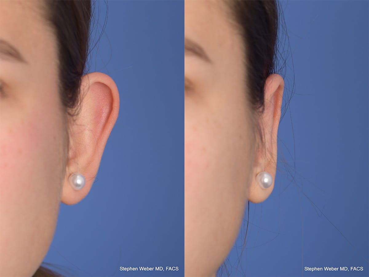 Otoplasty Before & After Gallery - Patient 111665 - Image 1