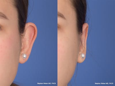 Otoplasty Before & After Gallery - Patient 111665 - Image 1
