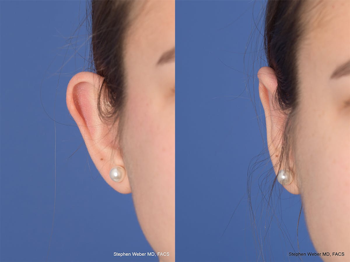 Otoplasty Before & After Gallery - Patient 111665 - Image 2