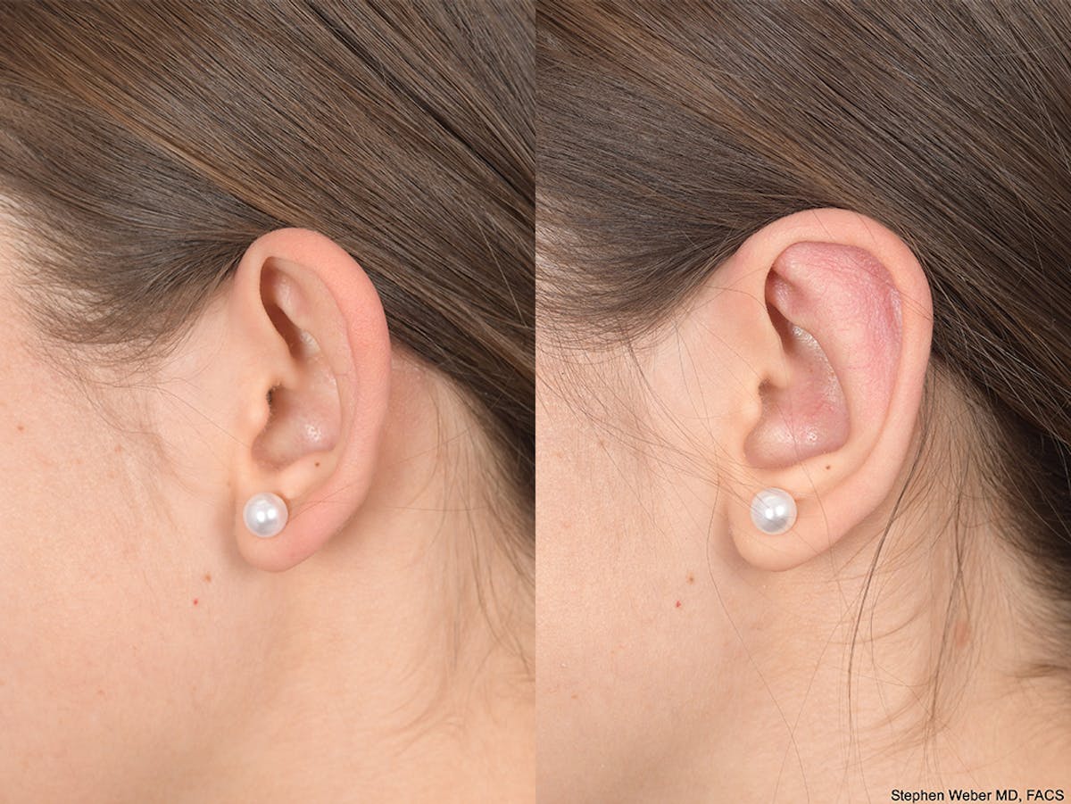 Otoplasty Before & After Gallery - Patient 111665 - Image 3