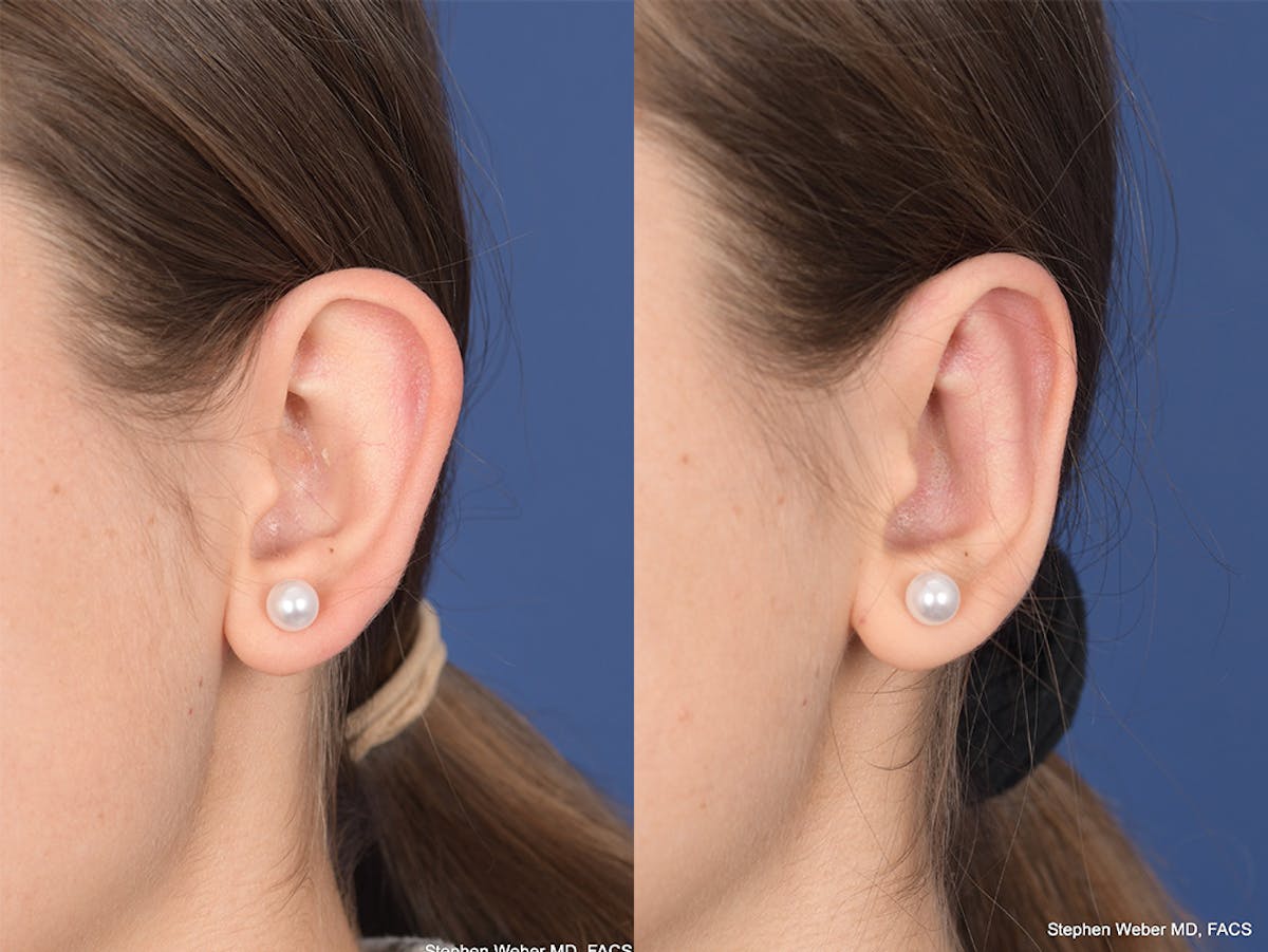Otoplasty Before & After Gallery - Patient 111665 - Image 4