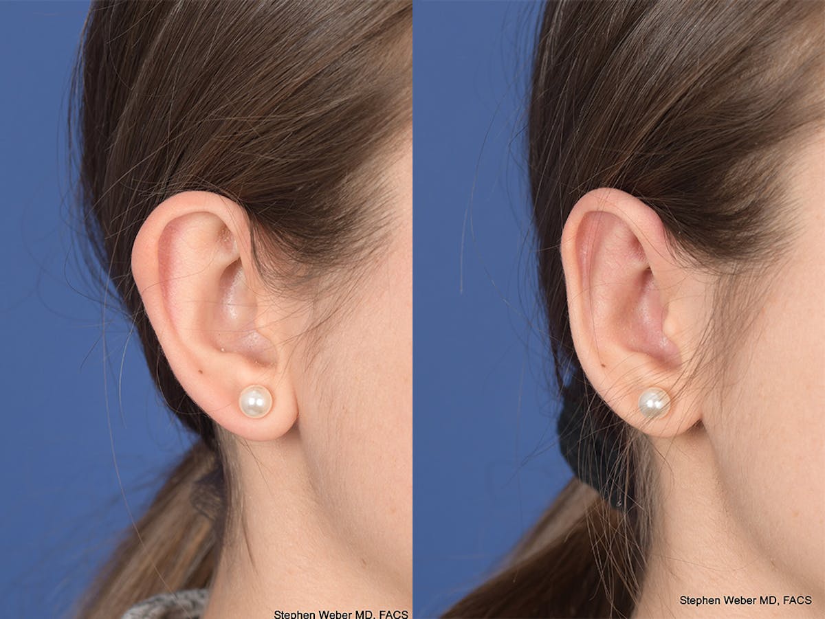 Otoplasty Before & After Gallery - Patient 111665 - Image 5