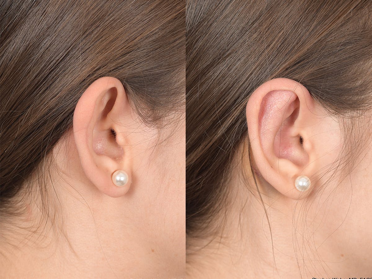 Otoplasty Before & After Gallery - Patient 111665 - Image 6