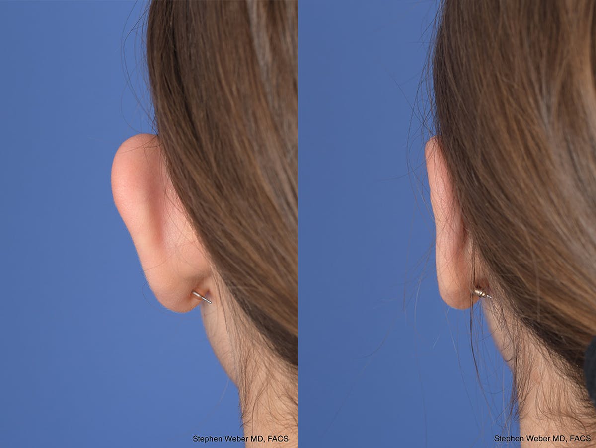 Otoplasty Before & After Gallery - Patient 111665 - Image 7