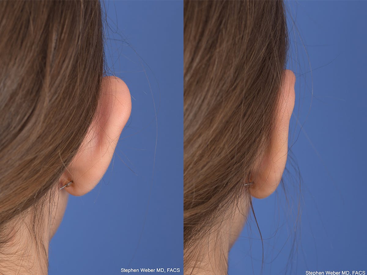 Otoplasty Before & After Gallery - Patient 111665 - Image 8