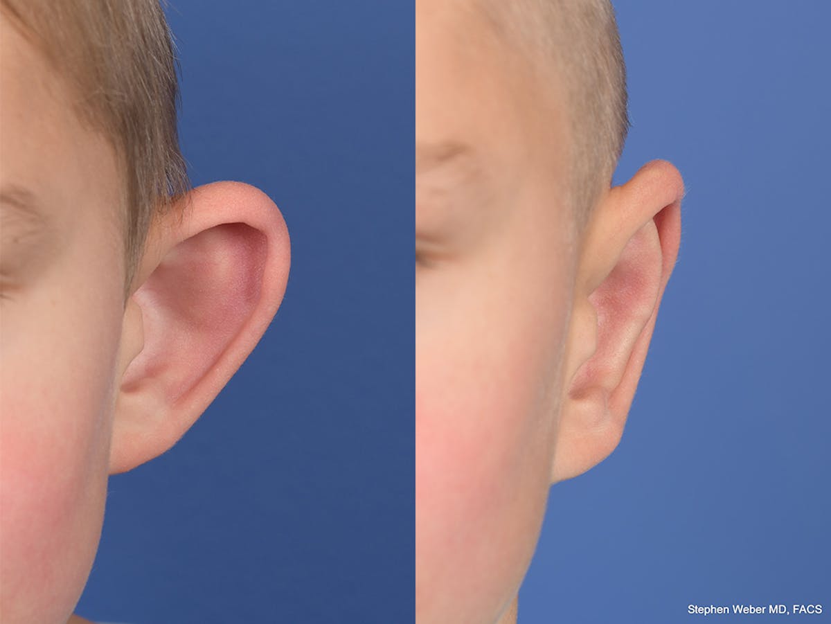 Otoplasty Before & After Gallery - Patient 556984 - Image 1