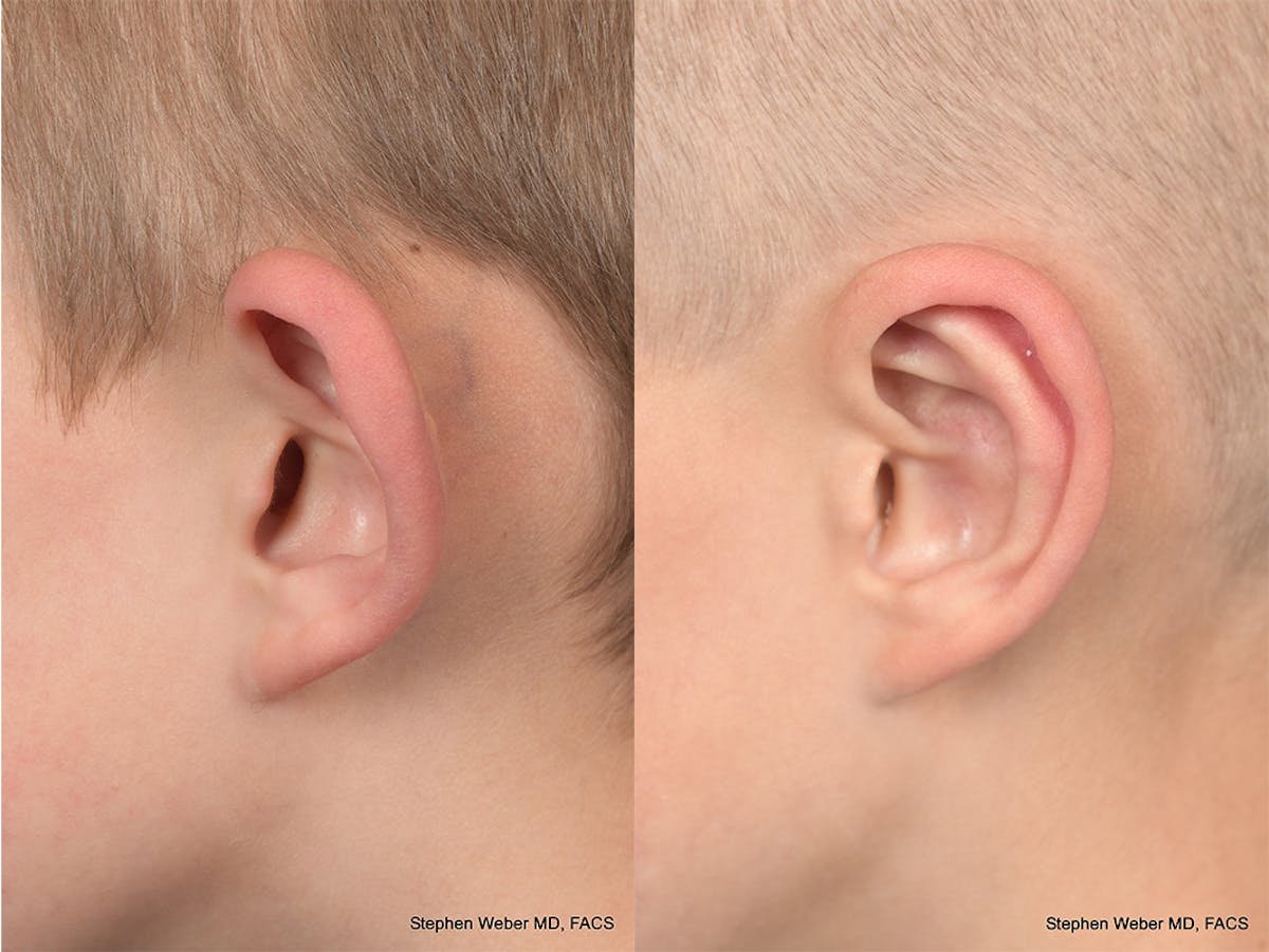 Otoplasty Before & After Gallery - Patient 556984 - Image 3