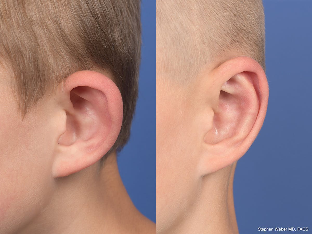 Otoplasty Before & After Gallery - Patient 556984 - Image 4