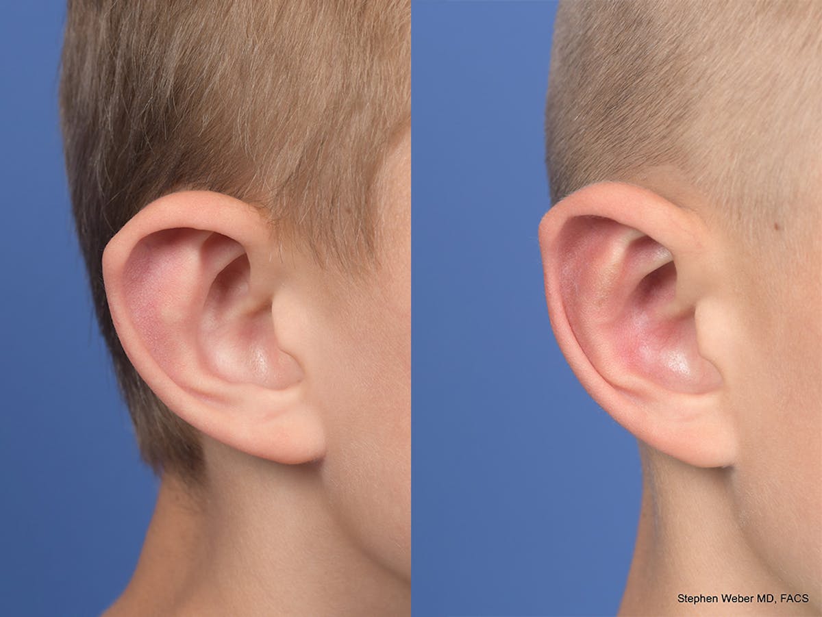 Otoplasty Before & After Gallery - Patient 556984 - Image 5